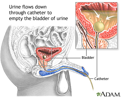 Bladder catheterization - male
