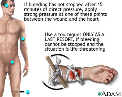 Stopping bleeding with a tourniquet