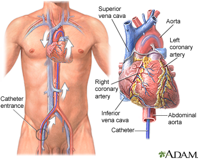 Cardiac catheterization