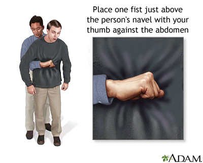 Heimlich maneuver on adult