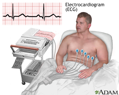 Peripheral artery disease and intermittent claudication