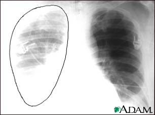 Aortic rupture - chest X-ray