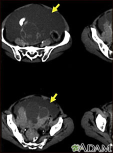 Ascites with ovarian cancer - CT scan