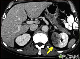 Kidney tumor - CT scan