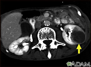 Kidney metastases - CT scan