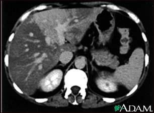 Liver with disproportional fattening - CT scan