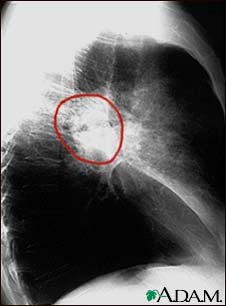 Lung cancer - lateral chest x-ray