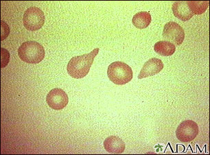 Red blood cells, tear-drop shape