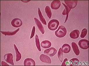 Red blood cells - multiple sickle cells