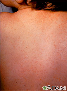 ECHO virus type 9 - exanthem