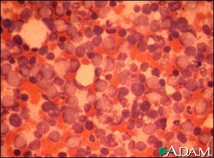 Chronic myelocytic leukemia