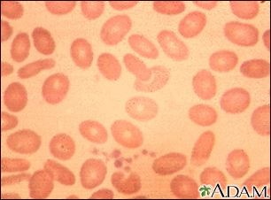 Ovalocytoses