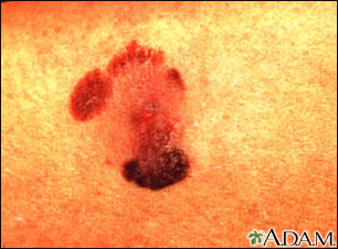 Skin cancer - malignant melanoma