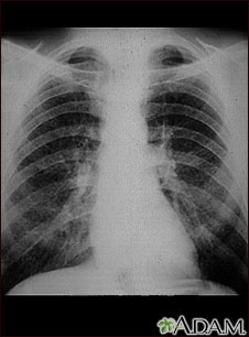 Coal worker's lungs - chest x-ray