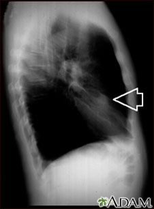 Lung nodule, right middle lobe - chest X-ray