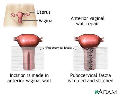 Anterior vaginal wall repair