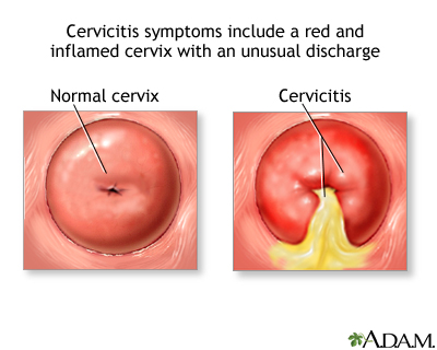 Cervicitis