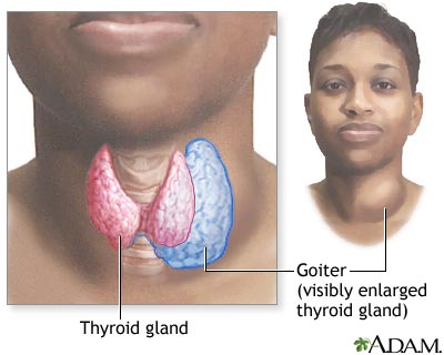 Hyperthyroidism