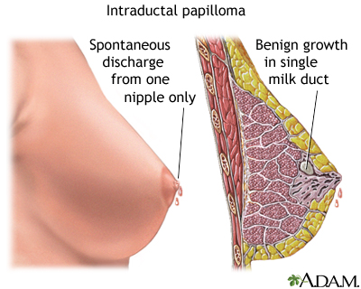 Intraductal papilloma