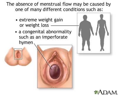 Absence of menstruation (amenorrhea)