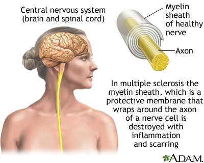 Multiple sclerosis