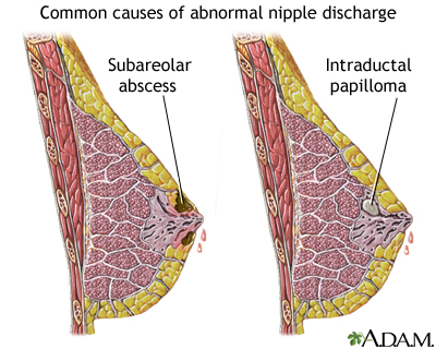 Abnormal discharge from the nipple
