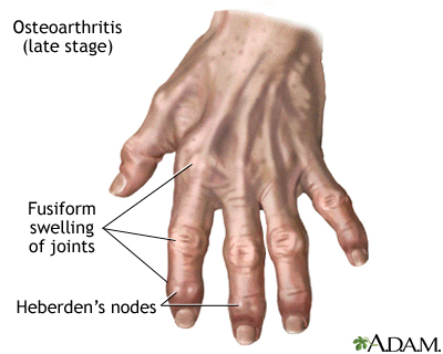 Arthrosis nodularis forma