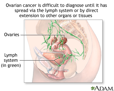 ovarian cancer with ascites