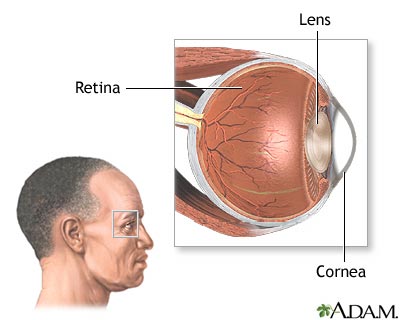 CMV retinitis
