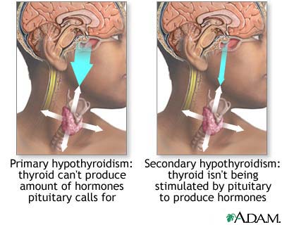 Primary and secondary hypothyroidism