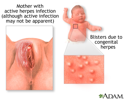 After herpes Herpes Pictures
