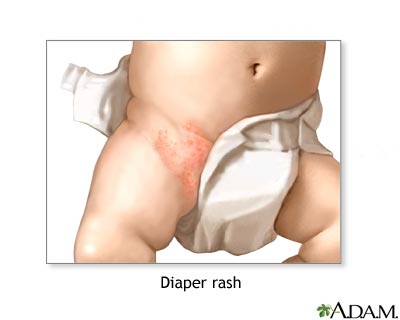 Diaper rash