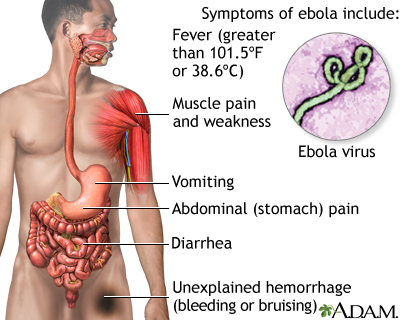 Ebola virus disease
