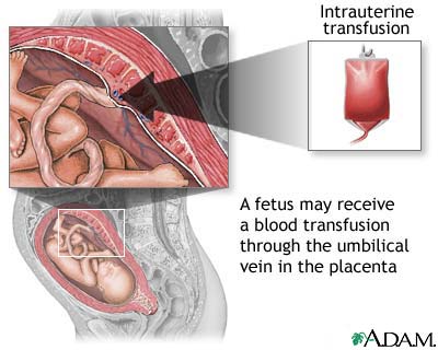 Intrauterine transfusion