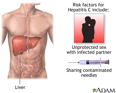 Hepatitis C