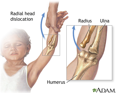 Radial head injury