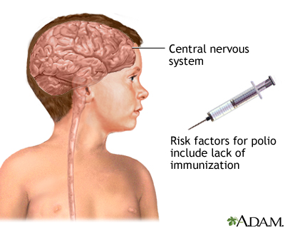 Poliomyelitis