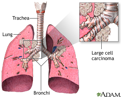 Large cell carcinoma