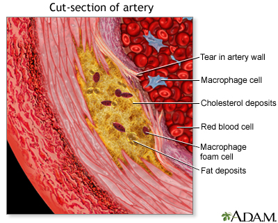 Enlarged view of atherosclerosis