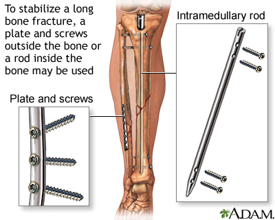 Internal fixation devices