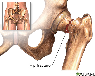 What is hip bursitis? – Midwest Center for Joint Replacement