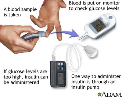 Glucose test