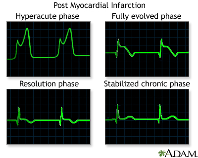 Post myocardial infarction ECG wave tracings