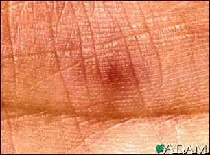 Janeway lesion - close-up