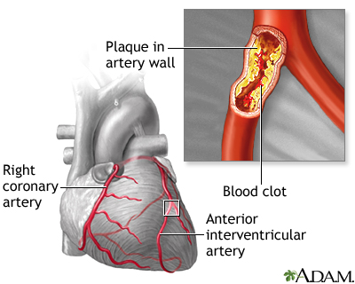 Atherosclerosis