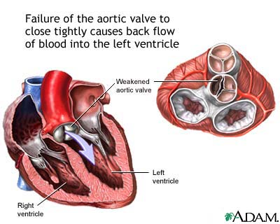 Aortic insufficiency