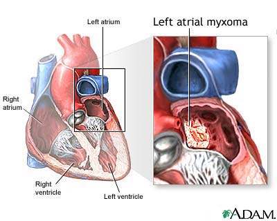 Left atrial myxoma