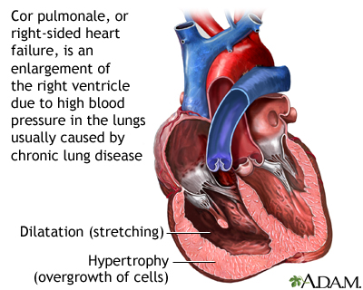 Cor pulmonale