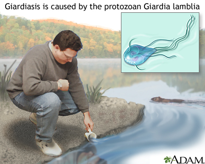 giardia infection for years)