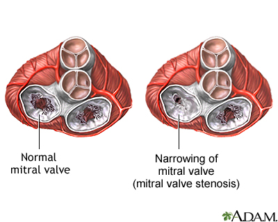 Mitral stenosis | Lima Memorial Health System